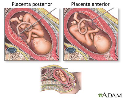 Muestreo percutáneo de sangre del cordón umbilical