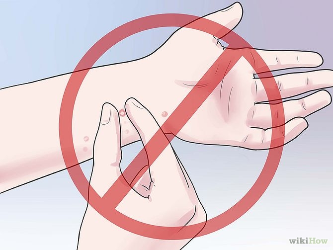 Treat a Fire Ant Sting Step 9.jpg